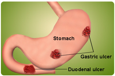 prevent gastric disease